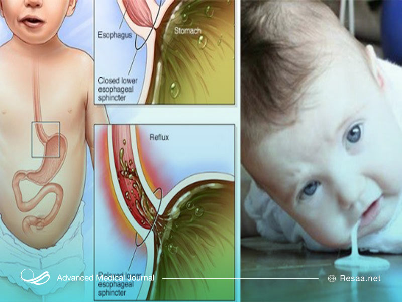 گاهی اوقات برای درمان بیماری رفلاکس گزینه جراحی مطرح میشود.