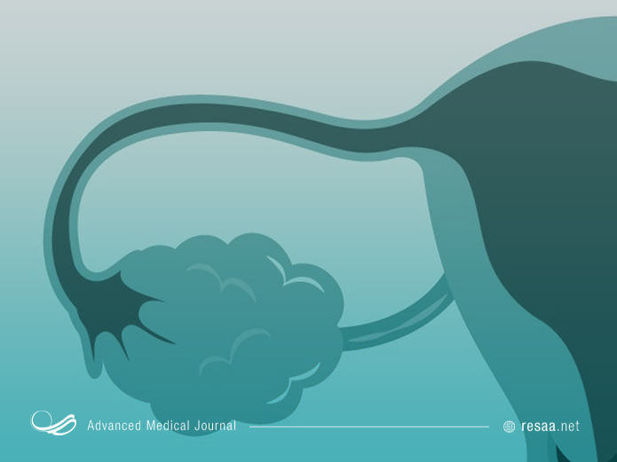 با افزایش سن، و بین سنین 40 تا 50 احتمال سرطان تخمدان افزایش می یابد
