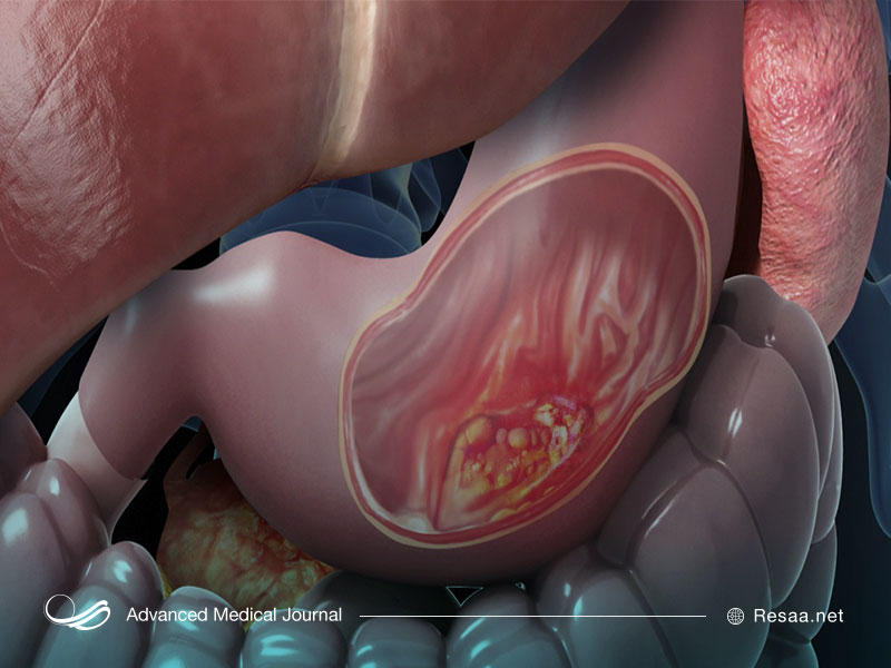 سرطان معده چگونه بوجود می آید