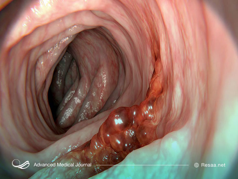 سرطان روده چیست؟