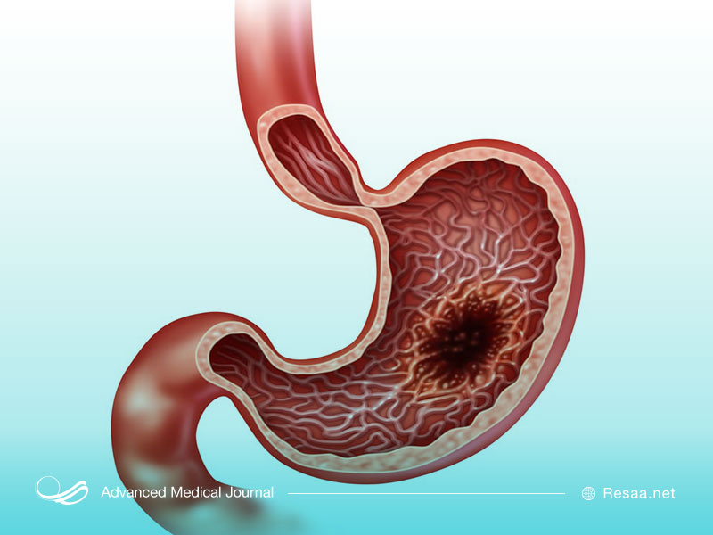شرایط سرطانی معده را بشناسید