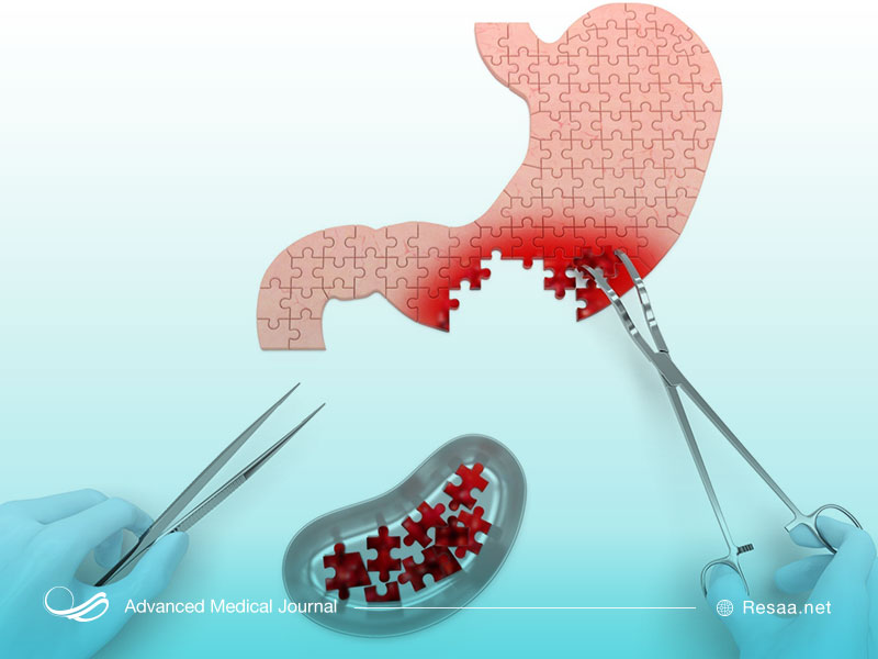 عمل جراحی برای درمان سرطان