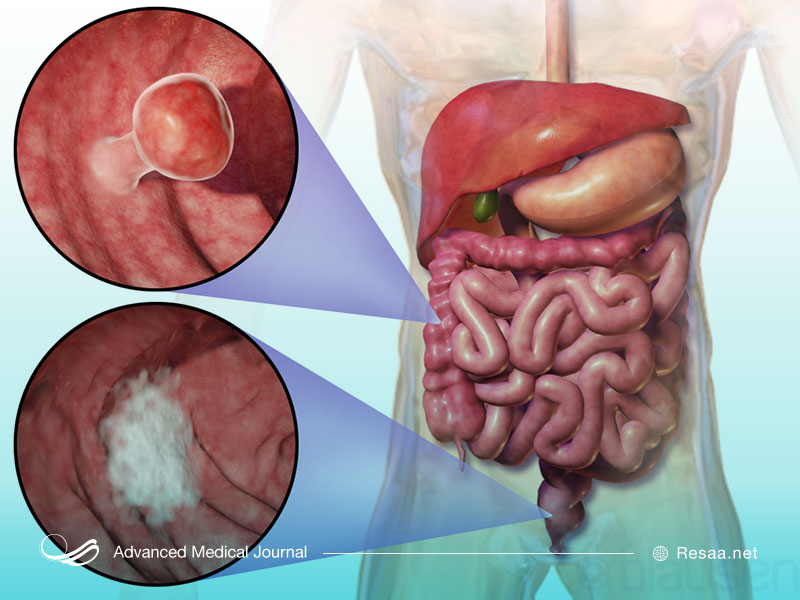 درمان سرطان روده
