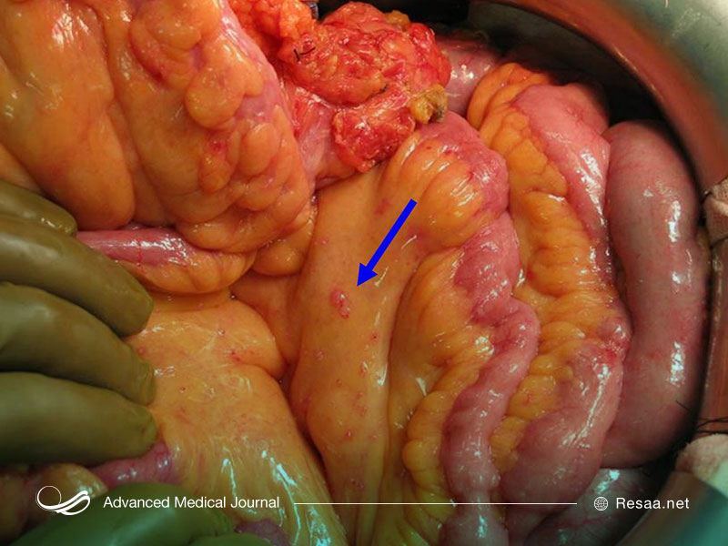 جراحی معده برای درمان سرطان