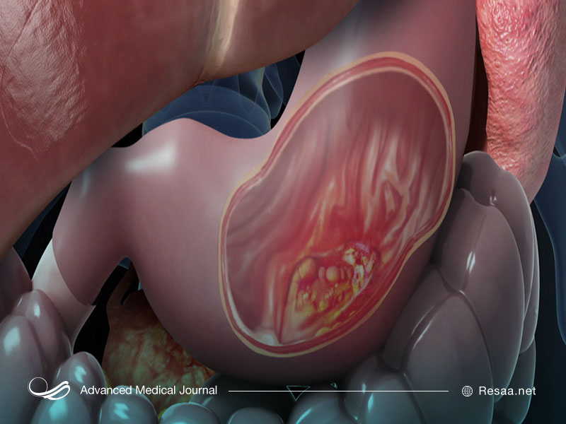 چطور سرطان معده را پیش بینی کنیم