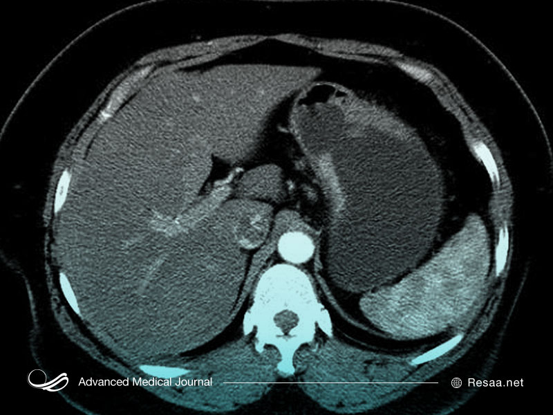 پرتو درمانی برای معالجه سرطان معده