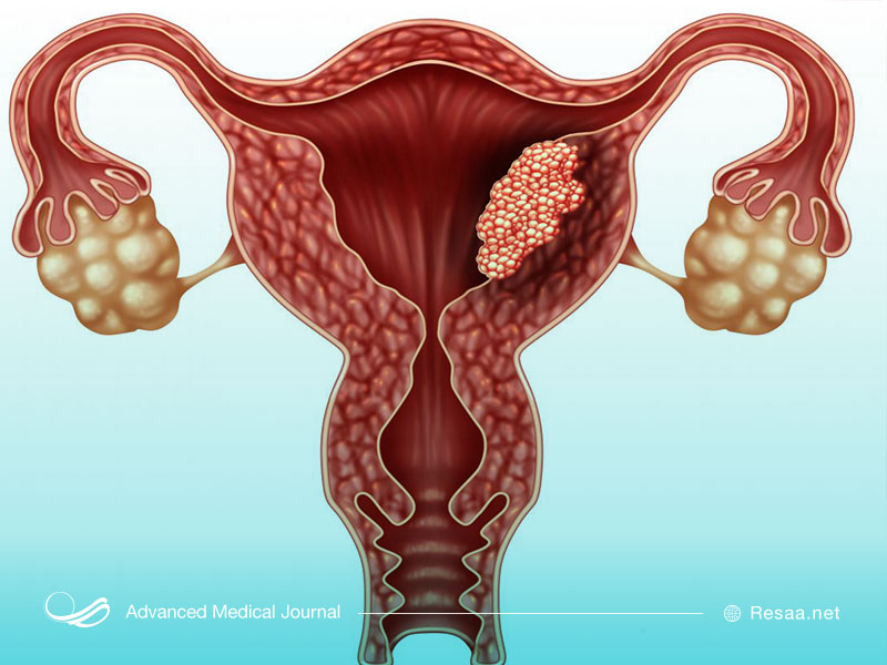 هر زنی ممکن است در معرض سرطان رحم قرار بگیرد.