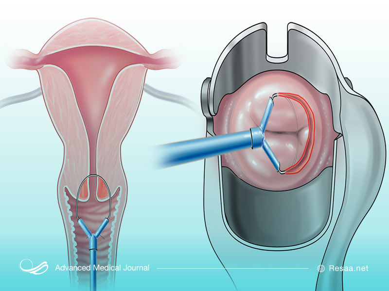 کورتاژ یک از درمان‌های مرتبط با سرطان رحم است.