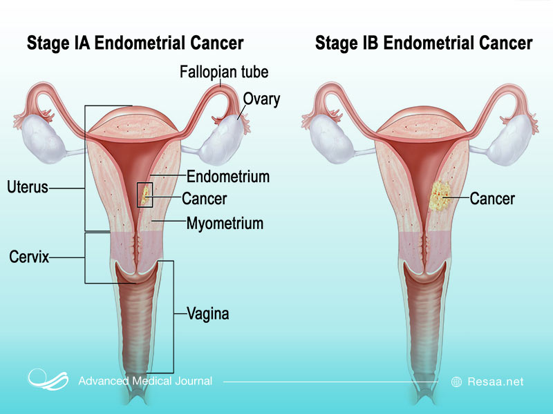 درجات و مراحل مختلف سرطان رحم