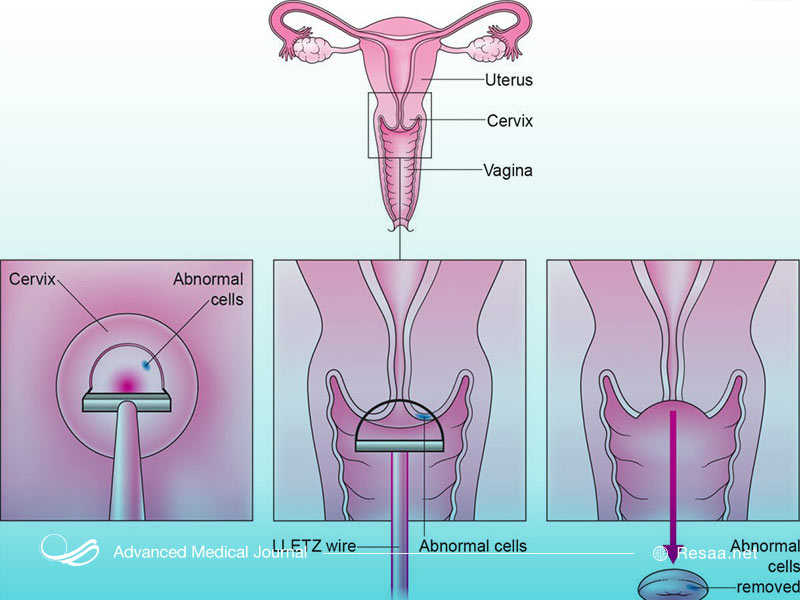 جراحی های مربوط به سرطان رحم مواردی مثل سرویکس یا کورتاژ هستند.
