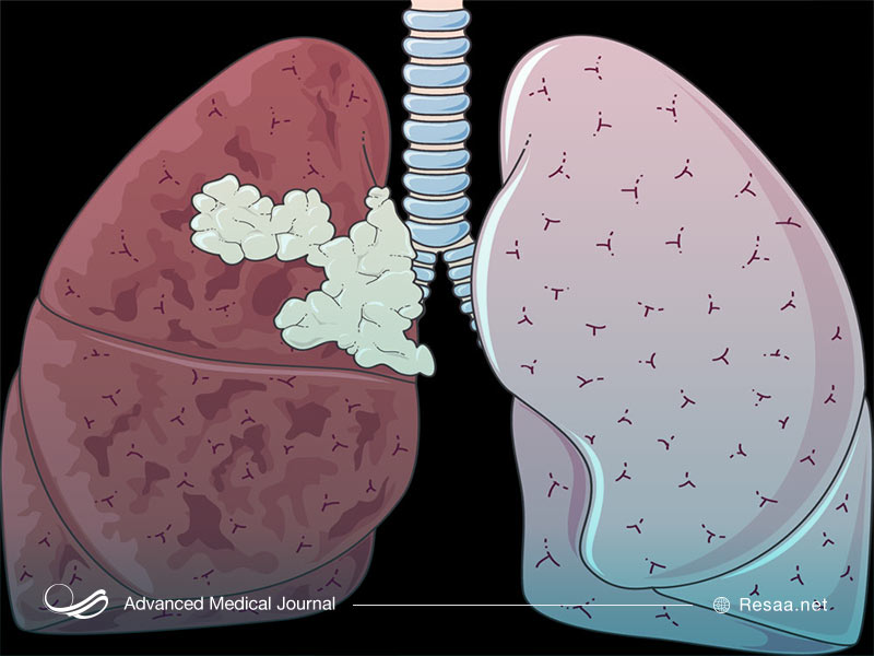 سرطان ریه چیست