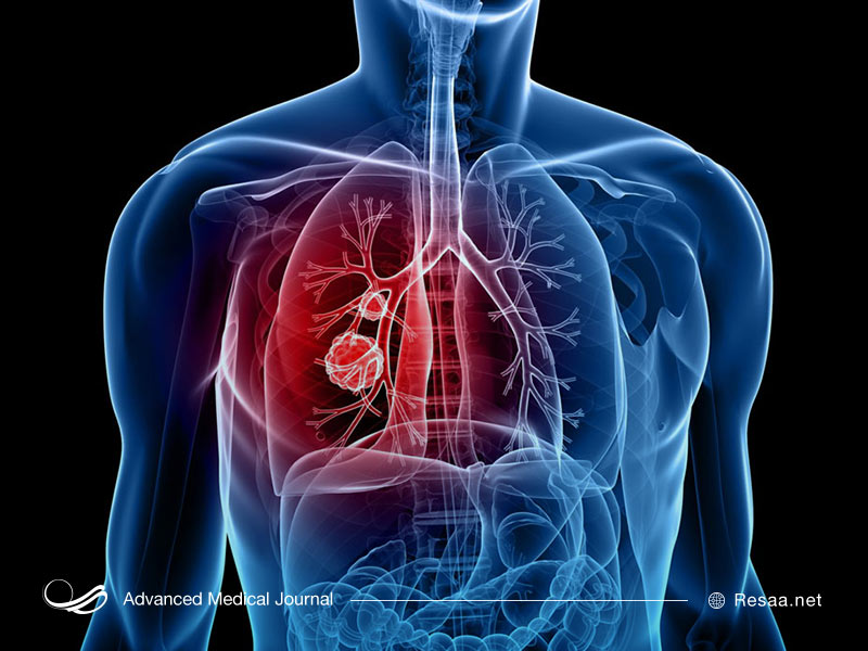 علل ابتلا به سرطان ریه