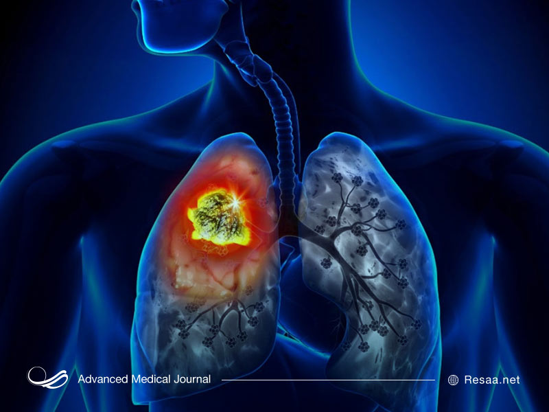علل ابتلا به سرطان ریه چیست