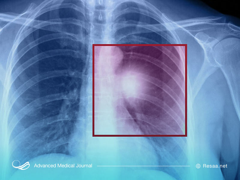 تشخیص سرطان ریه