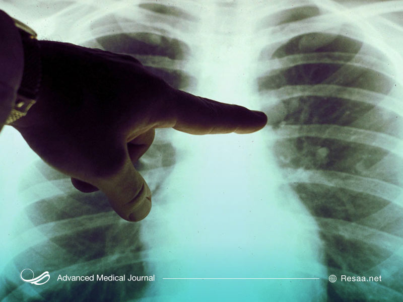 درمان سرطان ریه