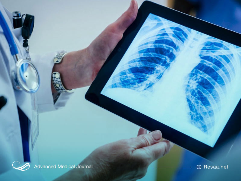 پیشگیری از سرطان ریه