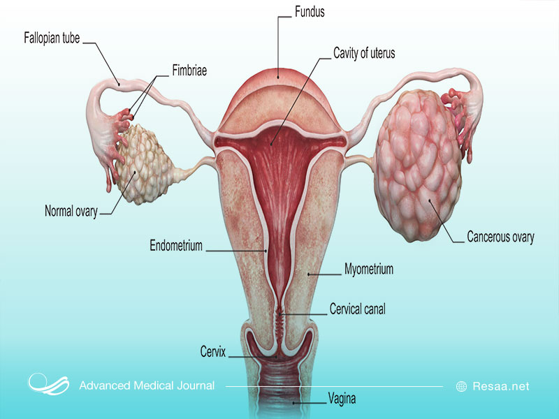 علت ایجاد سرطان تخمدان