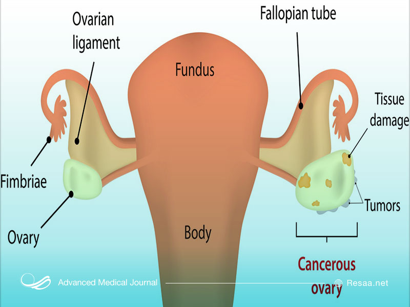 تخمدان درگیر بیماری سرطان