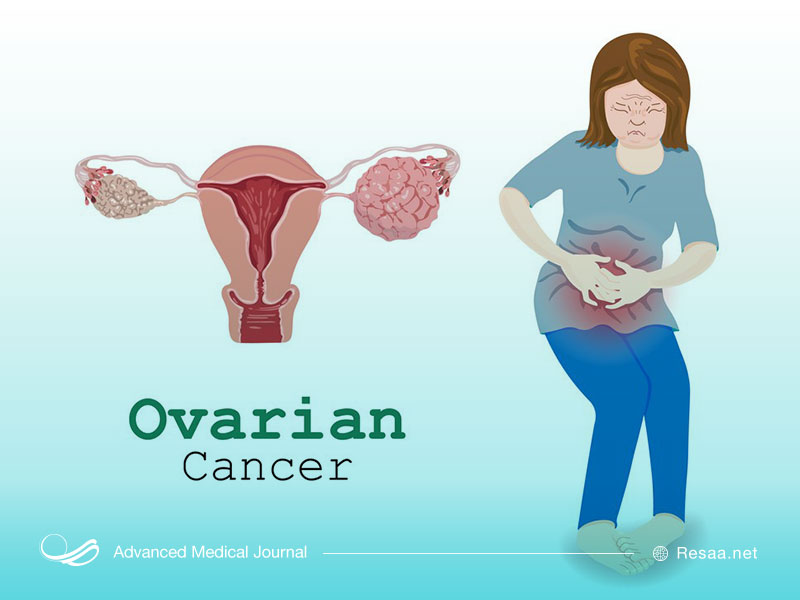 تشخیص و درمان سرطان تخمدان