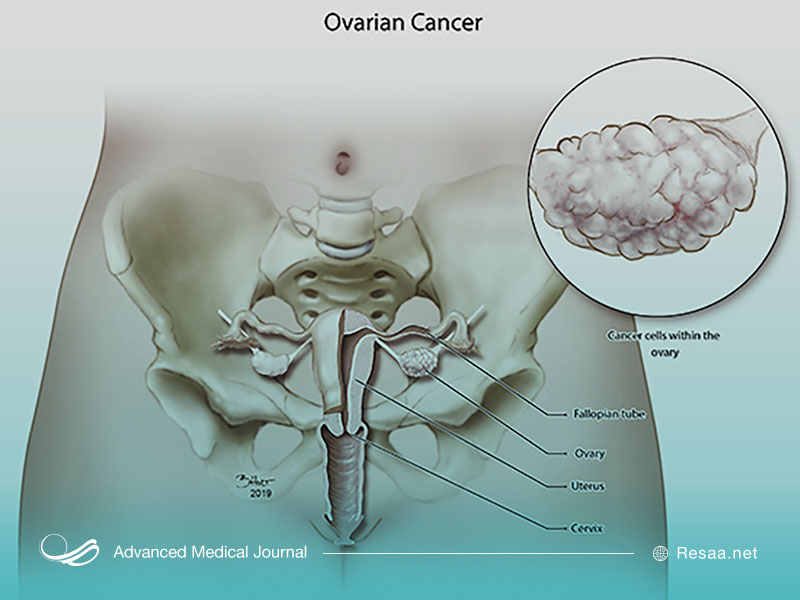 بیماری سرطان تخمدان