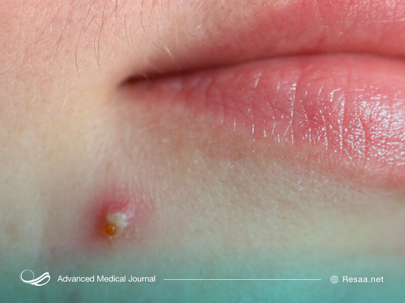 آکنه بیشتر در سنین بلوغ افراد را درگیر می‌کند.