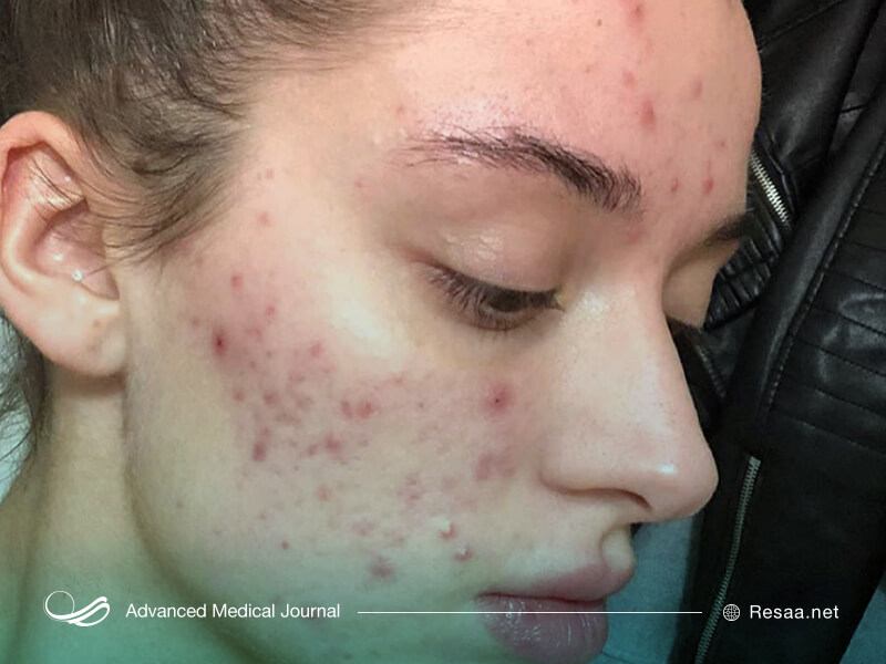 آکنه ممکن است به دلالیل مختلفی ایجاد شود.