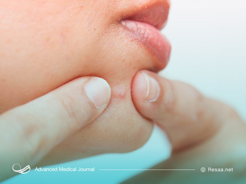 آکنه قابل درمان است.