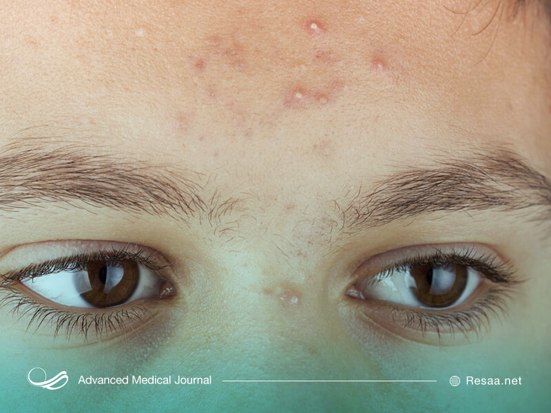 آکنه در زنان شایع تر است