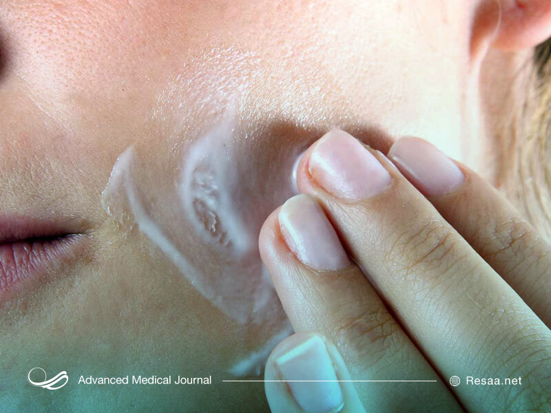 گاهی آکنه ریشه هورمونی دارد.