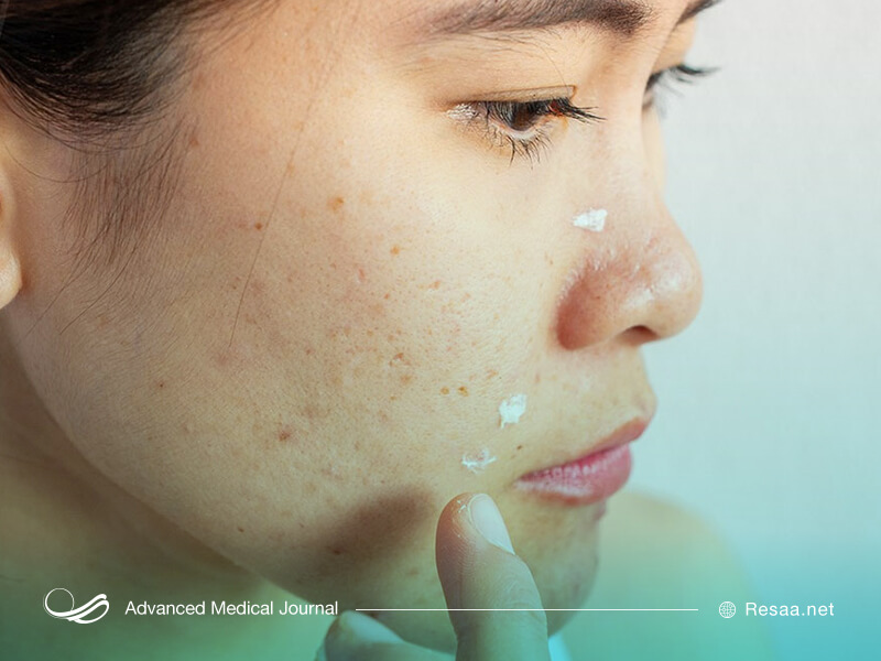 از رتینوئیدهای موضعی برای درمان آکنه استفاده می‌شود.