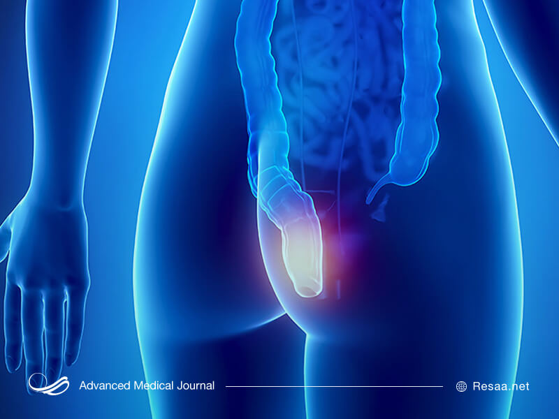  فیشر در اثر آسیب به کانال روده و مقعد ایجاد می شود.