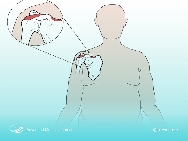 در صورت ادامه دار بودن درد بازو باید حتما علت آن را مشخص نموده و اقدام به رفع آن نمایید.
