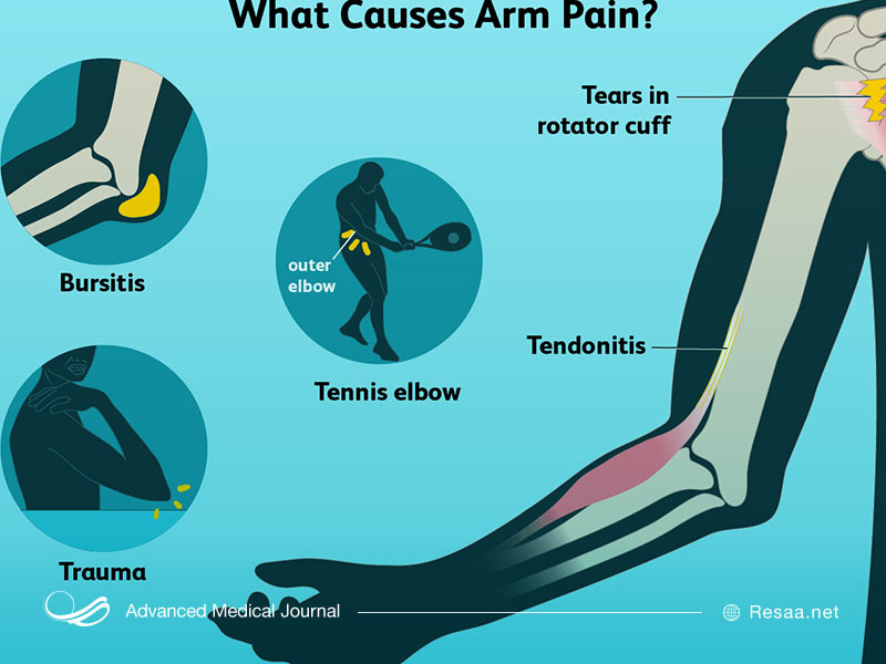 عوامل مختلفی در ایجاد درد بازو نقش دارند.