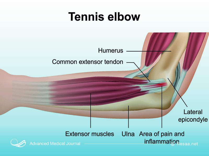 تنیس آرنج بازان یکی از عوامل بازو درد میباشد.