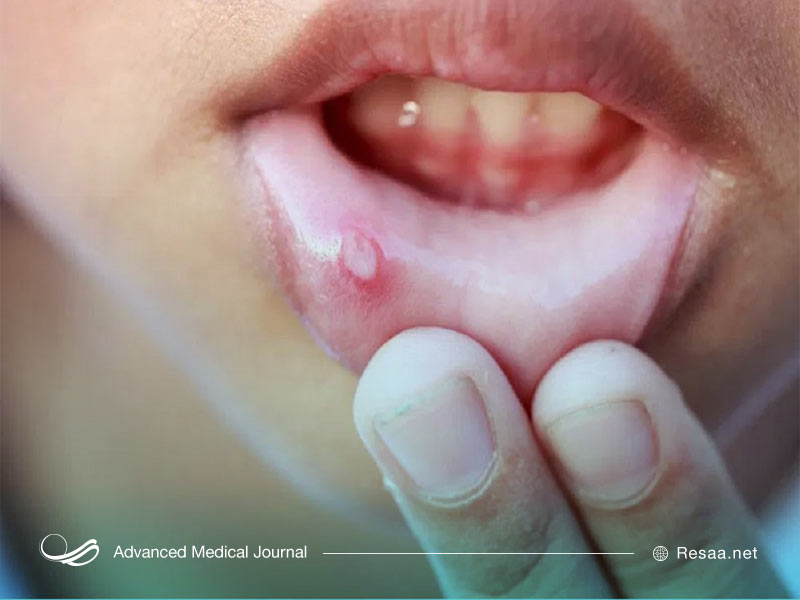 بیماری بهجت در اثر التهاب رگهای خونی ایجاد میشود.