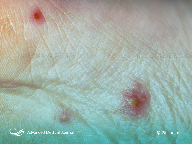 بیماری بهجت ممکن است به شکل زخمهای دهانی یا اسیبهای پوستی بروز پیدا کند.