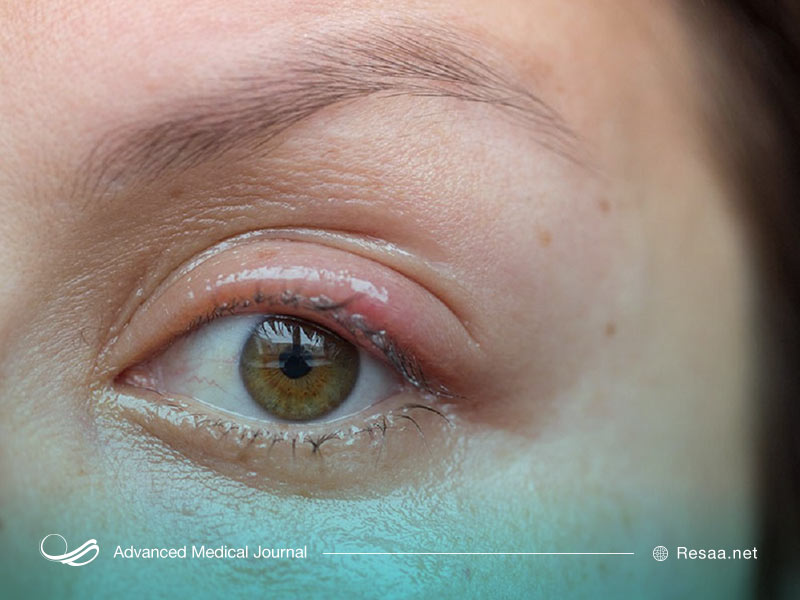 وضعیت چشمها در بیماری بهجت