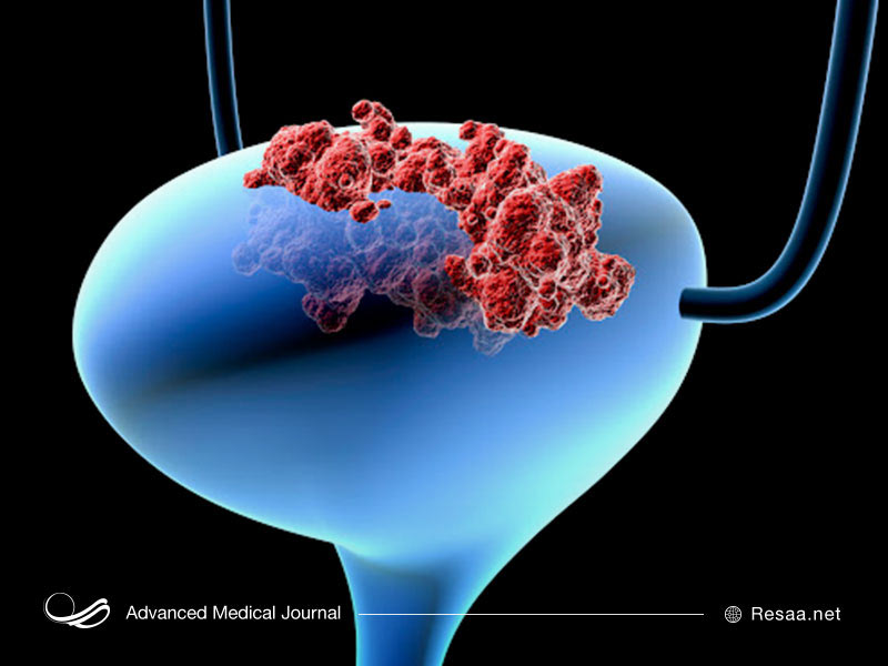 تومورهای سرطانی مثانه را بشناسیم