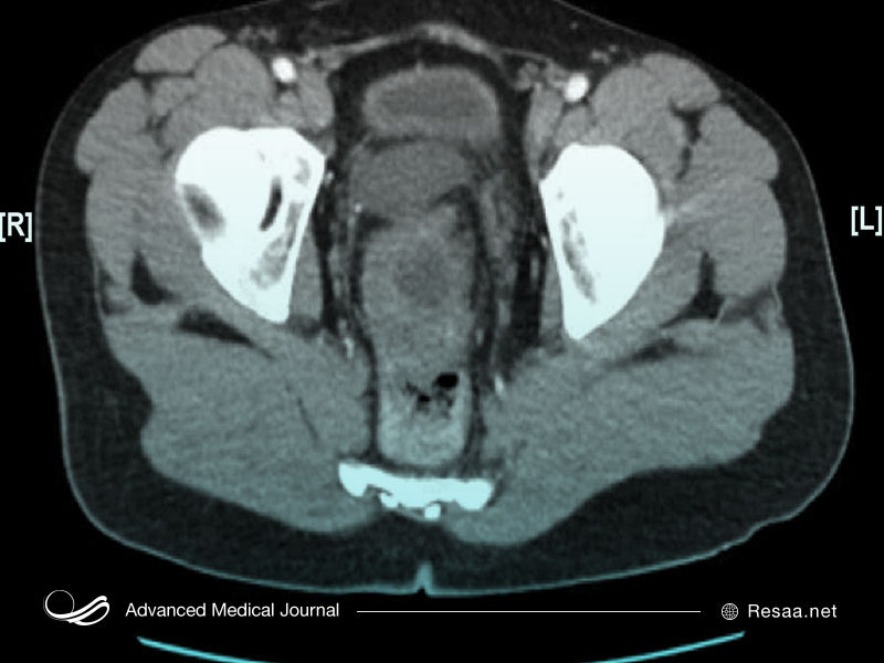 سرطان ادراری یا کارسینوم سلول ادراری