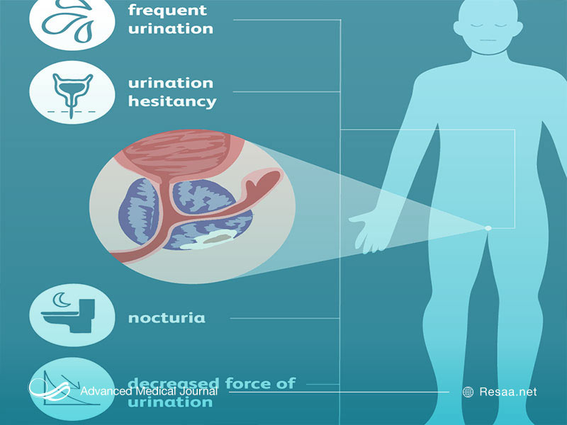 روش های درمانی سرطان مثانه