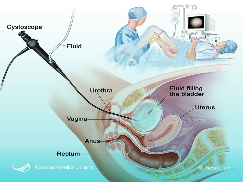 عمل جراحی برای درمان سرطان مثانه