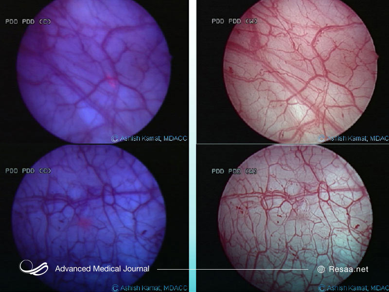 ایمونوتراپی و درمان با دارو در سرطان مثانه