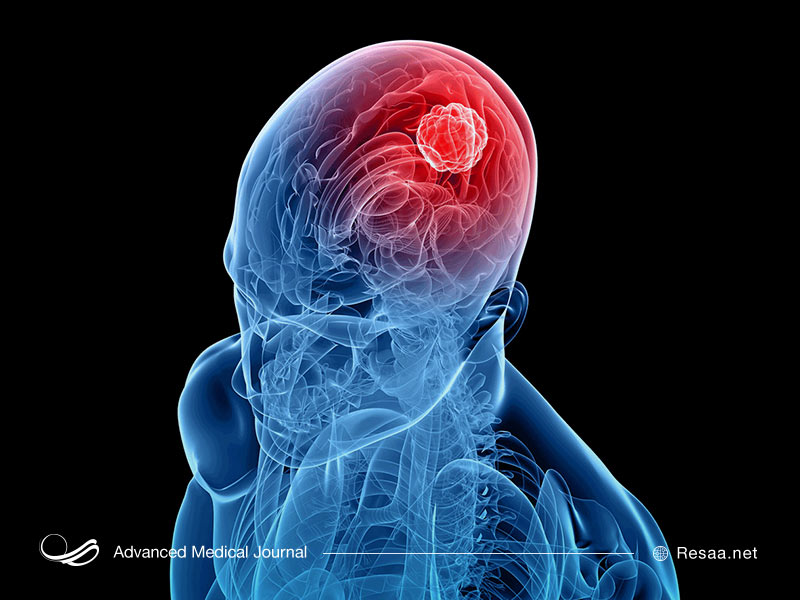 تومورهای خوش خیم و بدخیم مغزی