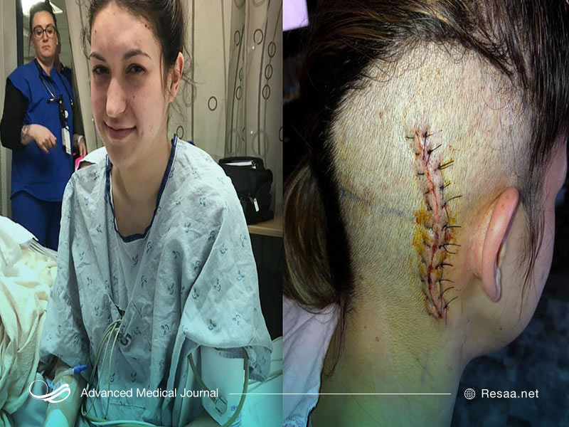 انواع سرطان مغز