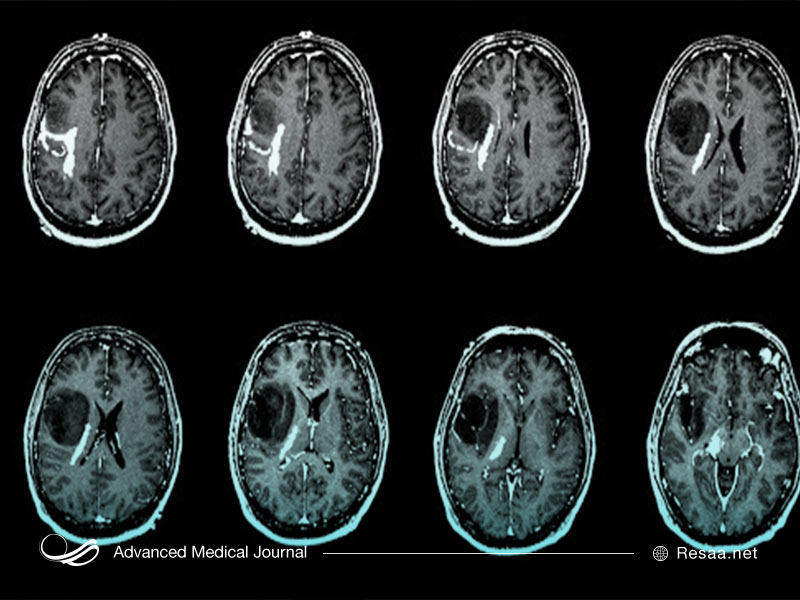 پرتو درمانی برای معالجه سرطان مغز