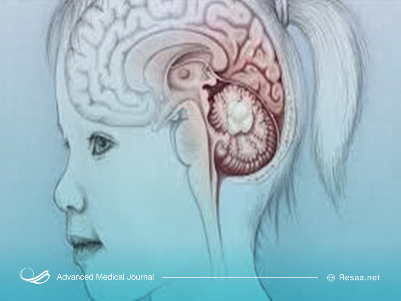 تومورهای مغزی