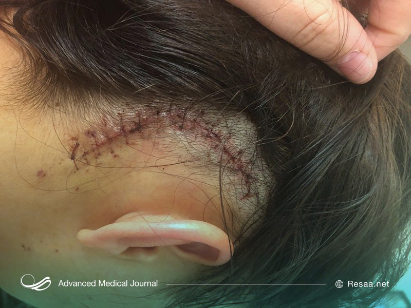 برای درمان سرطان مغز به چه کسی مراجعه کنیم