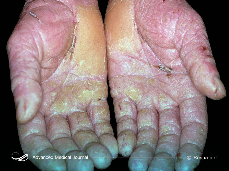 تاول زدن پوست یکی از علائم بیماری پروانه ای است.