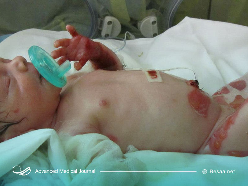 بیماری ای بی در چهار نوع مختلف بروز می کند.