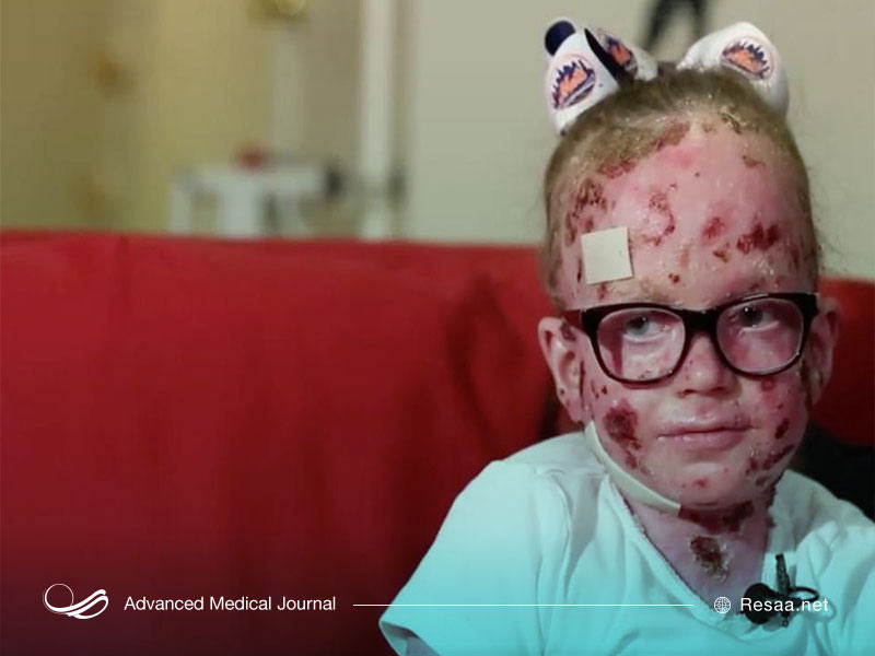  ای بی باعث ایجاد زخم روی دست ها و پاهای بیماران می‌شود.